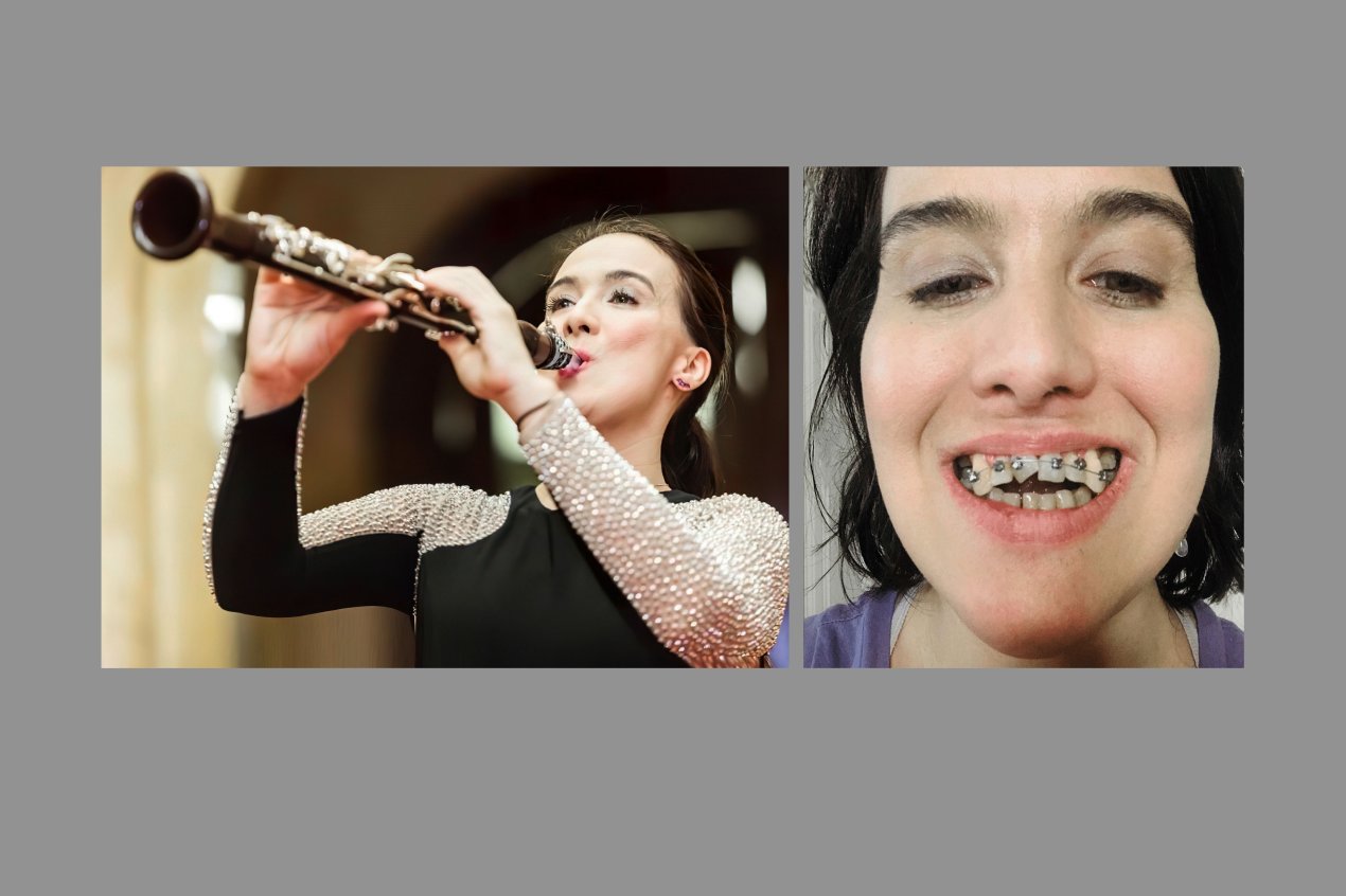 Two photos are shown side by side. The left is of a young woman playing a clarinet at a concert. The right is of the same woman showing her misaligned teeth.